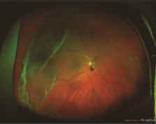 retinaldetachment